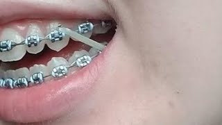 COMECEI A USAR ELÁSTICO NOS DENTES  ROTINA DA MANHÃ😬 aparelhoortodôntico elastico rotinadamanha [upl. by Teagan]