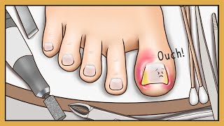 Tingle ASMR Animation Ingrown Toenail Removal with Stimulating Sound  Ondong  Happy Lemon [upl. by Johansen]