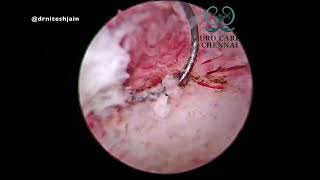 Bladder Mass on Left Ureteric Orifice  How to deal [upl. by Hay]