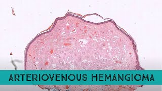 quotArteriovenousquot Hemangioma pathology dermpath dermatology dermatopathology [upl. by Irra]