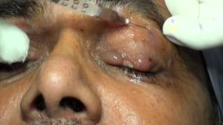 Botulinum Toxin Injection for Blepharospasm and Hemifacial Spasm Drs Vidushi Suresh Pandey SuVi Eye [upl. by Cestar964]