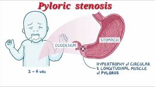 Pyloric stenosis mrcpch Video station [upl. by Aneertak]