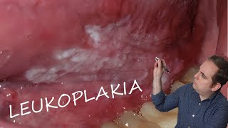 Leukoplakia Common Oral Pathology [upl. by Ecnar]