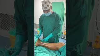 How LASER is used to treat varicose vein [upl. by Ahtiekahs158]