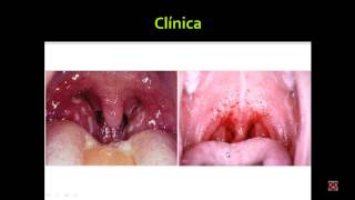 Faringoamigdalitis Agentes infecciosos Dx diferencial Viralbacteriana Tratamiento Infectología [upl. by Reynolds972]