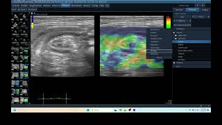 IQ 265 PANCREATIC ULTRASOUND ECHOPAC ANALYSIS ELASTOGRAPHY [upl. by Nehte63]