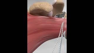 Subscapularis tendon repair  animationshorts shortsfeed youtubeshorts viralshorts [upl. by Annuahsal529]