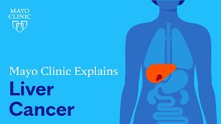 Mayo Clinic Explains Liver Cancer [upl. by Lisab286]