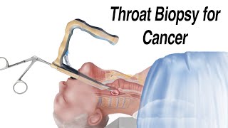 How a Throat Biopsy is Performed to Check for Throat Cancer [upl. by Natsreik]