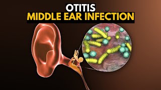 Middle Ear Infection Otitis Media Causes SIgns and Symptoms Diagnosis and Treatment [upl. by Esnofla612]