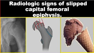 Radiologic signs of Slipped Capital Femoral Epiphysis [upl. by Aitnwahs]