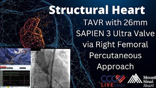 TAVR with 26mm SAPIEN 3 Ultra Valve via Right Femoral Percutaneous Approach [upl. by Nuahsal156]