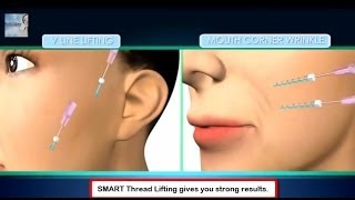 Smart Spiral Thread Lift NonSurgical Face Lift [upl. by Rowan634]