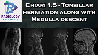 Chiari 15  Tonsillar herniation along with Medulla descent [upl. by Zeralda]