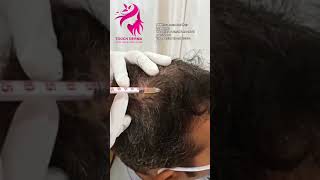 PRP Treatment for Hair PRP plateletrich plasma at Touch Derma Clinic us80778432577840050530 [upl. by Guzel57]