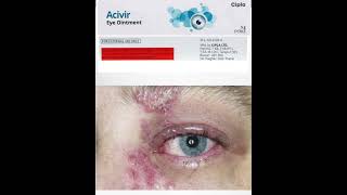 acivir eye ointment 3wv  acyclovir 3 eye ointment  antiviral eye drops uses dosage [upl. by Nnylf]