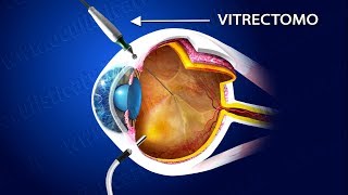 Retinopatia diabetica proliferante terapia laser e chirurgica [upl. by Xenophon]