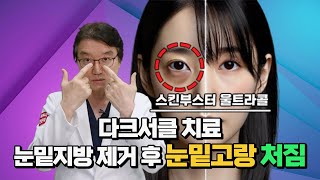 다크서클 눈밑지방 눈밑주름으로 어두운 경우 치료 눈밑지방제거 울트라콜 스킨부스터시술 다크서클눈밑지방 [upl. by Aicilat732]