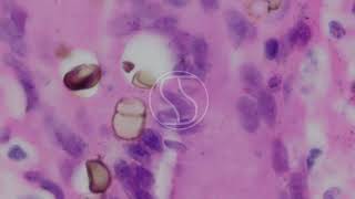 Chromoblastomycosis Haematoxylin and Eosin HampE Staining [upl. by Yasmeen]