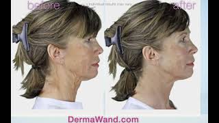 DermaWand retail 30 [upl. by Lothair]