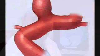 Flow Diversion for Intracranial Aneurysms  Mayo Clinic [upl. by Gayelord]