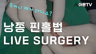 쾌감 영상 얼굴 턱 핀홀법 live surgery 낭종 수술 핀홀법 피지낭종 표피낭종 성형외과 서울 병원 epidermal cyst pinhole아문TV [upl. by Anelagna857]