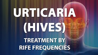 Urticaria Hives  RIFE Frequencies Treatment  Energy amp Quantum Medicine with Bioresonance [upl. by Eelannej]