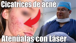 CICATRICES de ACNÉ 👧👨 CÓMO ELIMINARLAS con LASER CO2 FRACCIONADO 🤩 Dr ALBERTO CALVO QUIROZ [upl. by Ileak874]