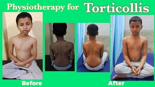 Torticollis Physiotherapy treatmentWry Neck Exercises Torticollis stretching exercises [upl. by Darwin423]