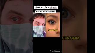 Central Heterochromia Doctors Opinion [upl. by Manbahs]