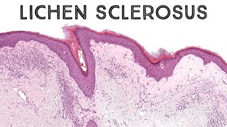 Lichen sclerosus with epidermotropism mimic of mycosis fungoides pathology dermatology dermpath [upl. by Constancy893]