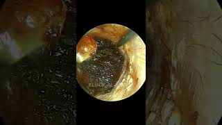 Agonizing Painful Impacted Earwax🤯 [upl. by Blanding914]