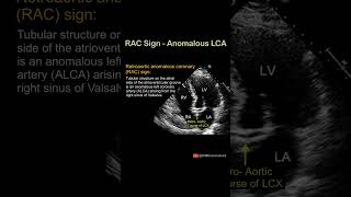 RAC Sign of Anomalous LCA echocardiography cardiology science [upl. by Zehe]