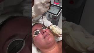 Facial capillaries laser treatment  Fotona Starwalker laser [upl. by Viccora]