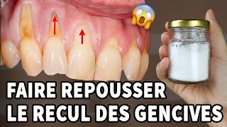 Incroyable Il S’agit D’un Remède À La Maison Pour La Récession Gingivale [upl. by Nahgem]