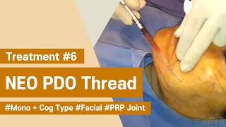 NeoGenesis Thread Series PDO Cog  Mono Type Facial Joint Procedure with PRP [upl. by Mochun612]