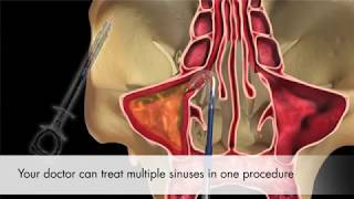 Balloon Sinus Dilation  Entellus [upl. by Ab]