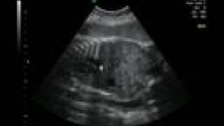 Life in the Womb IV 33 weeks ultrasound [upl. by Hudis]