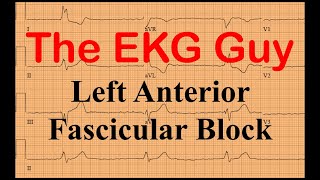 EKGECG Practice 650  Left Anterior Fascicular Block  The EKG Guy [upl. by Eittocs]