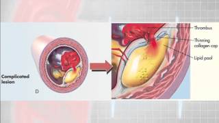 12 Lead Interpretation Part 61 Pathophysiolgoy of Myocardial Infarctions [upl. by Jenifer]