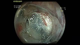 Rectal Sircular Lateral spreading Tumor Endoscopic Submucosal Dissection ESD [upl. by Schilling423]