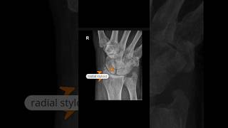 Radial styloid avulsion fracture xray anatomy [upl. by Ainevul]