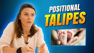 Positional Talipes  What You Need to Know [upl. by Aicilev]