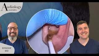 IRRIGATION OF HARD EAR WAX PLUG amp STUCK OTIP EXTRACTION EP832 [upl. by Gaudette561]