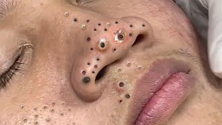 Big Cystic Acne Blackheads Extraction Blackheads amp Milia Whiteheads Removal Pimple Popping  389 [upl. by Aihsoj411]