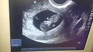 Baby Bell 10 week ultrasound [upl. by Cynthea]