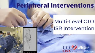 MultiLevel CTO ISR Intervention [upl. by Nnayd]