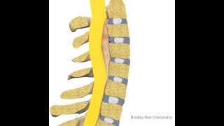 Ossified Posterior Longitudinal Ligament [upl. by Ahsieym]