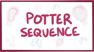 Potter sequence oligohydramnios  causes symptoms diagnosis treatment pathology [upl. by Euginomod826]