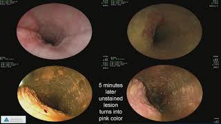 Early Detection of Esophageal Cancer and Barrett’s Esophagus Recent Advances [upl. by Koziel]